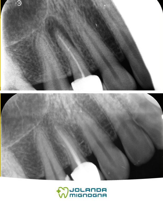 Prima e dopo Radiografie ritrattamento