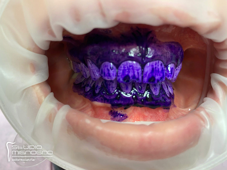 Applicazione del rilevatore di placca rilevatore placca applicato su denti